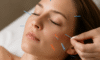 Cosmetic Acupuncture: Important Drawbacks to Weigh